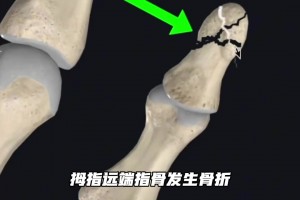 专业！国外知名运动康复博主分析登哥手指伤势：带护具就能打